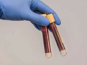 Menguak Alasan Susahnya Mendapat Donor Plasma Konvalesen