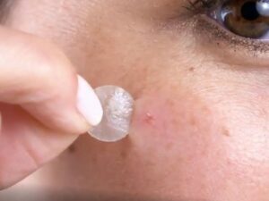 Hal yang Perlu Kamu Tahu Soal Acne Patch, Plester Tipis Penyembuh Jerawat 